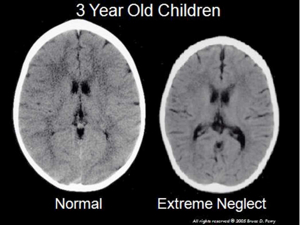 scan of 3 year old childs brain development